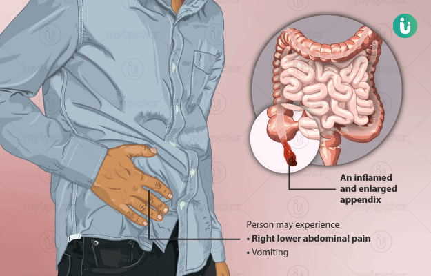 Symptoms appendicitis Acute appendicitis:
