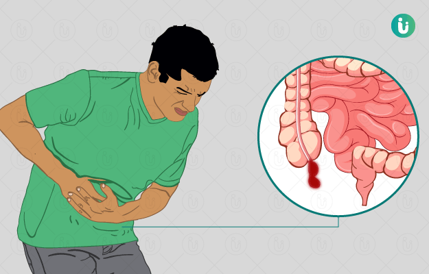 Appendicitis: symptoms, causes, treatment, medicine ...