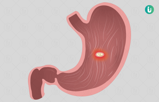 Peptic (Stomach) Ulcer: symptoms, causes, treatment, medicine