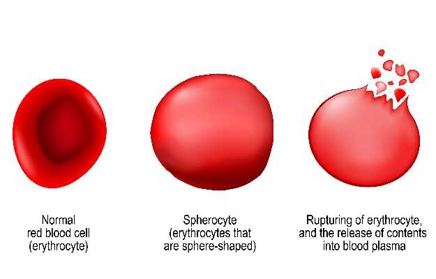 Hereditary Spherocytic Hemolytic Anemia