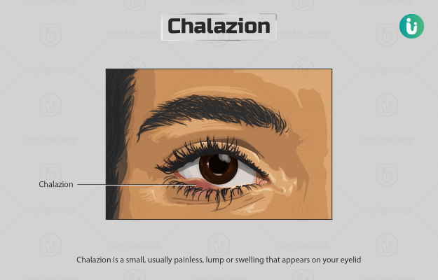 Chalazion