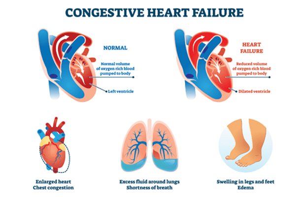 travelling with congestive heart failure