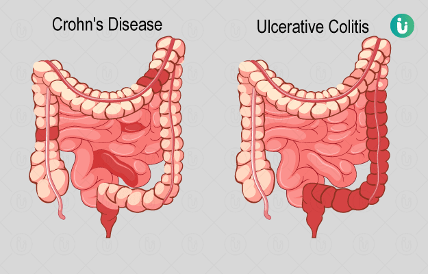 Inflammatory Bowel Disease Symptoms Causes Treatment Medicine 