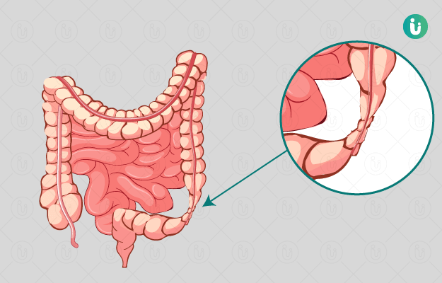 Irritable Bowel Syndrome Meaning In Hindi