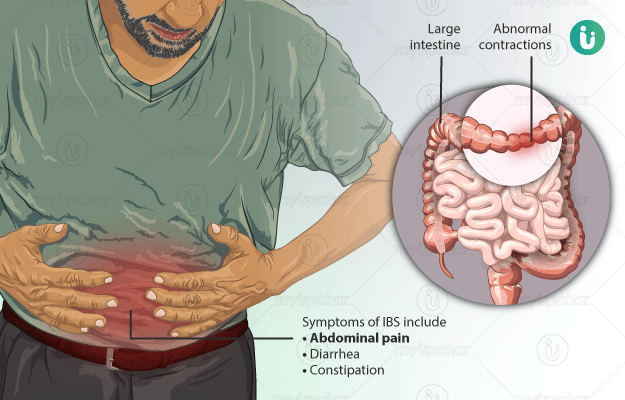Irritable Bowel Syndrome Ibs, Can Ibs Cause Large Stools