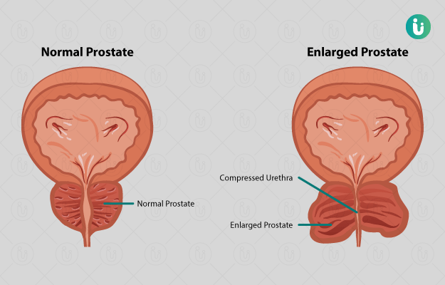 prostate infection in hindi