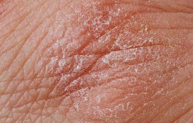 lichen sclerosus symptoms causes treatment medicine prevention diagnosis