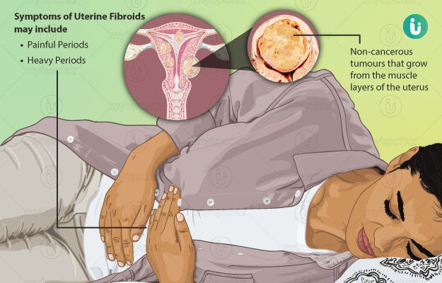 गर्भाशयातील फायब्रॉइड्स