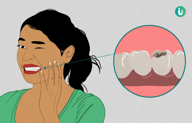 Cavities (Dental Caries)
