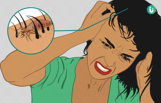 Head Lice: symptoms, causes, treatment, medicine, prevention, diagnosis
