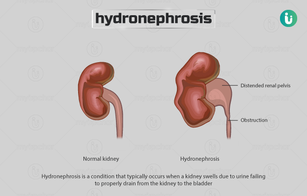 Hydronephrosis Symptoms Causes Treatment Medicine Prevention Diagnosis