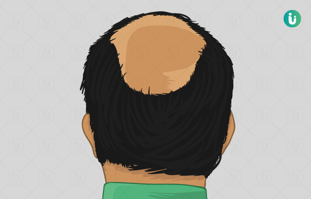 Permanent Hair Extensions in Sangli- Permane | Prem Hair Expert LYNX Pune