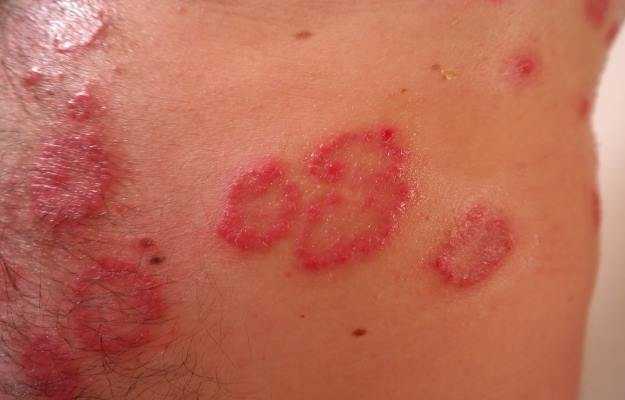 eczema meaning in hindi