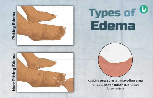 Swelling Edema Symptoms Causes Treatment Medicine Prevention 