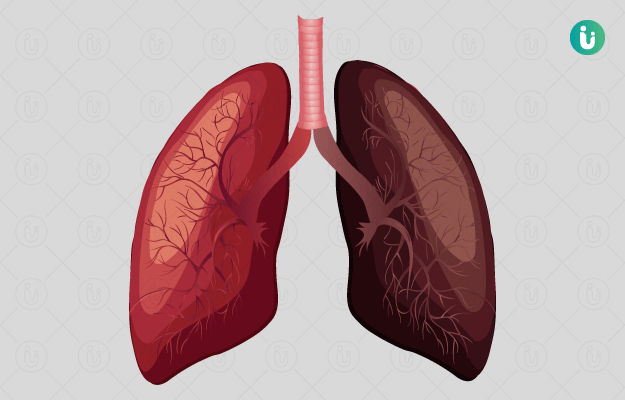 lung-infections-symptoms-causes-treatment-medicine-prevention