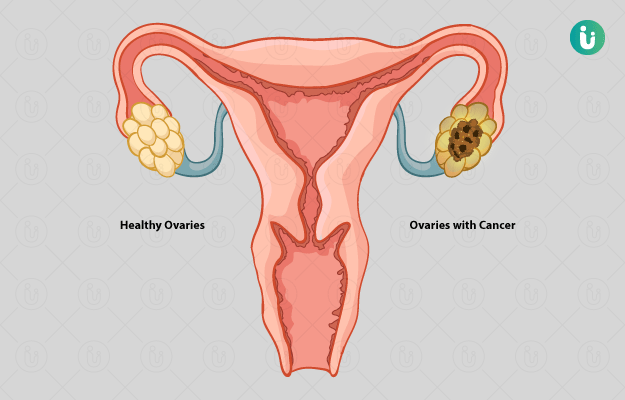 Ovarian cancer ke lakshan, Ovarian cancer ke lakshan