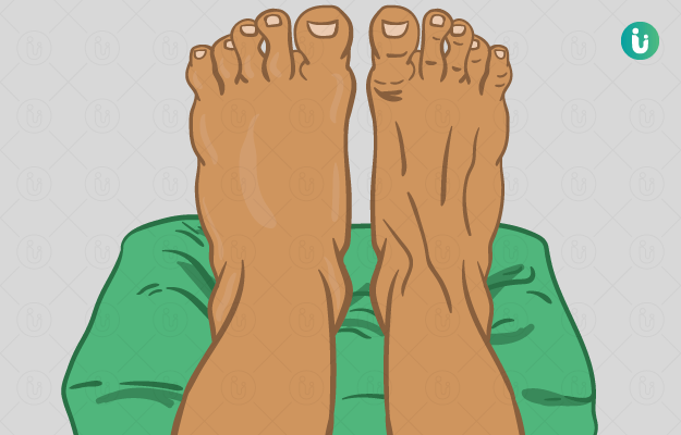 पैरों में सूजन के कारण, इलाज, दवा, उपचार, लक्षण - Swelling in Feet causes,  treatment, doctor, medicine, prevention in Hindi