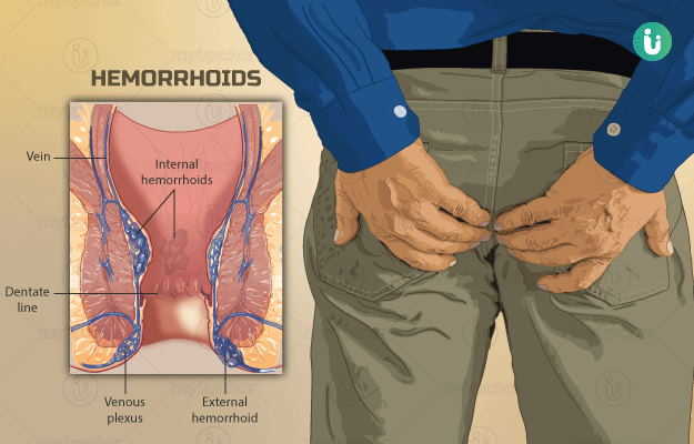 Meaning hemorrhoids Hemorrhoidal disease: