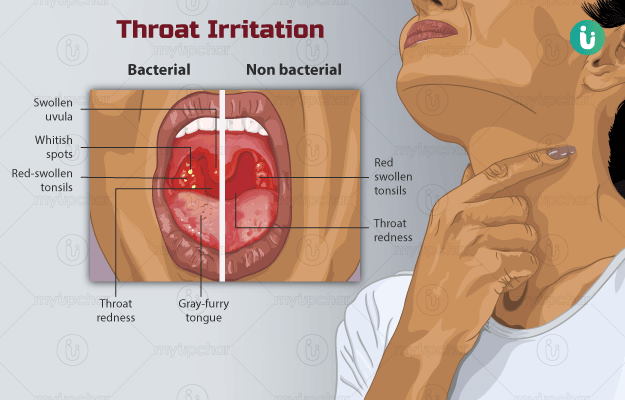  Itchy Throat 