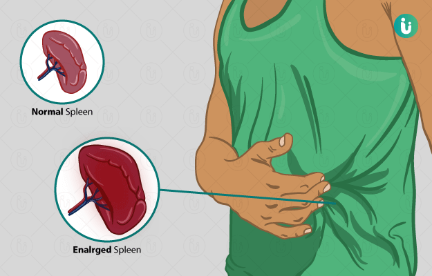 Normal And Enlarged Spleen