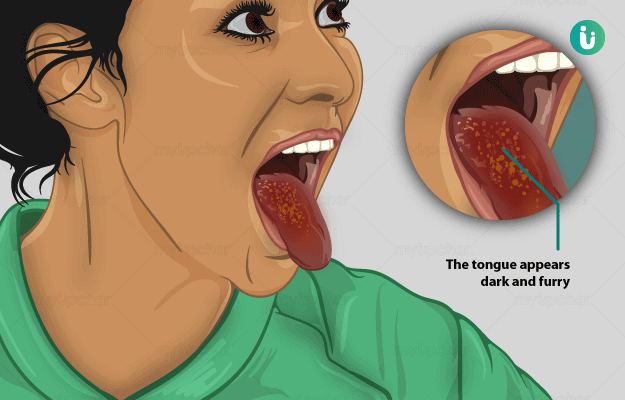 Tongue Ulcers