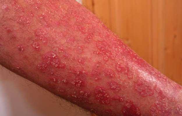 Allergic Angiitis and Granulomatosis