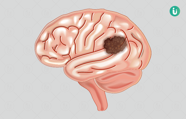 brain-tumour