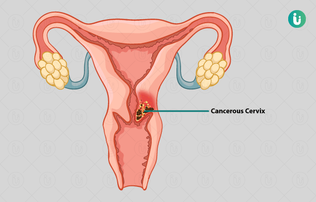 गर्भाशय ग्रीवा का कैंसर