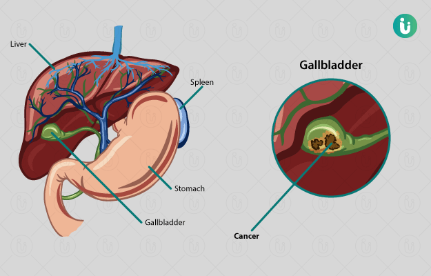 Gallbladder Cancer - Pictures