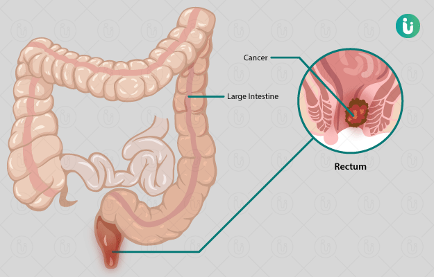 Cancer in rectal area symptoms