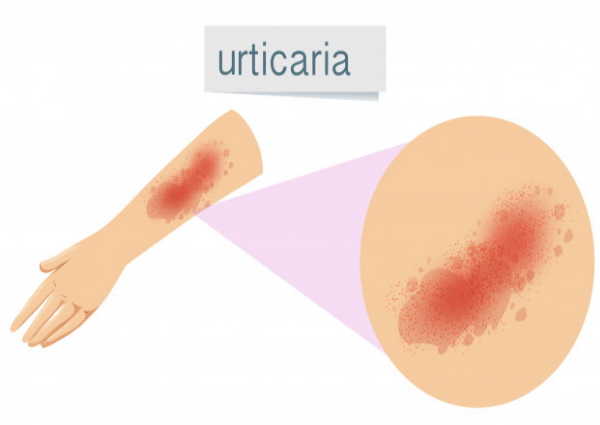 फिजिकल अर्टिकेरिया