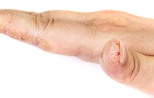 Cracked hand skin